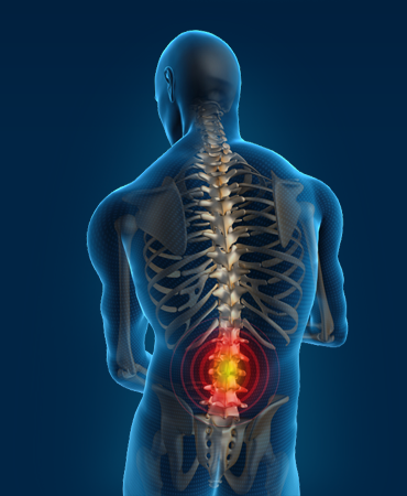 Ostry bol w dolnej czesci kregoslupa